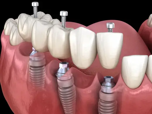 Azonnali implantáció az Oral Care Hungary Klinikán!