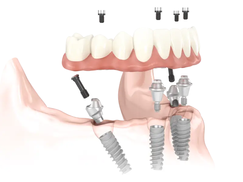  Implantológia mesterfokon: All-on-4™