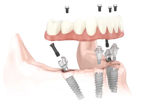 Implantológia mesterfokon: All-on-4™ Implantológia mesterfokon: All-on-4™